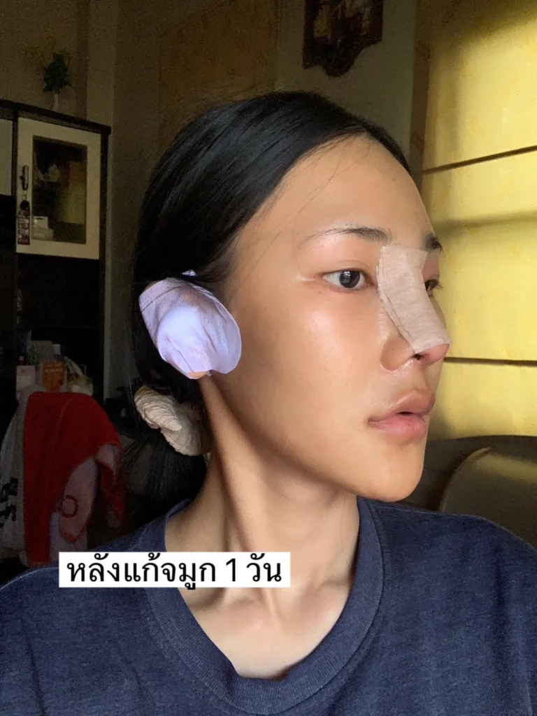 แก้จมูก
