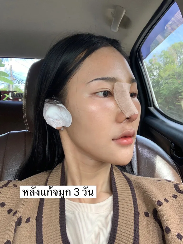 แก้จมูก