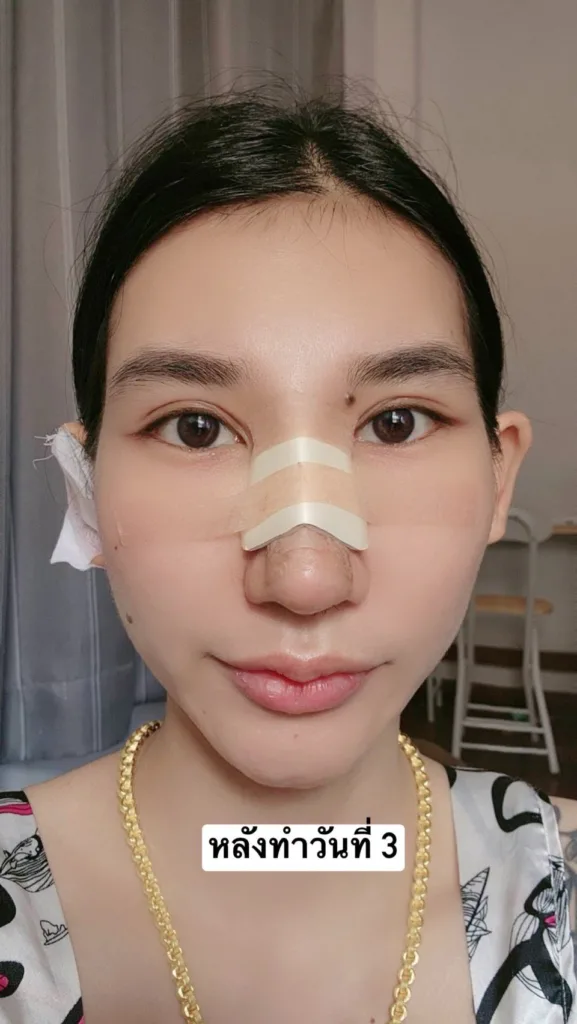 จมูกเอียง