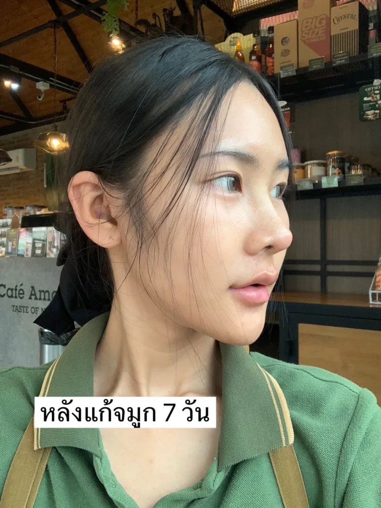 แก้จมูก