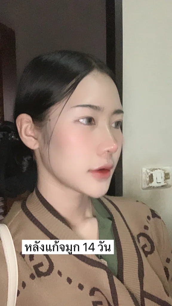 แก้จมูก