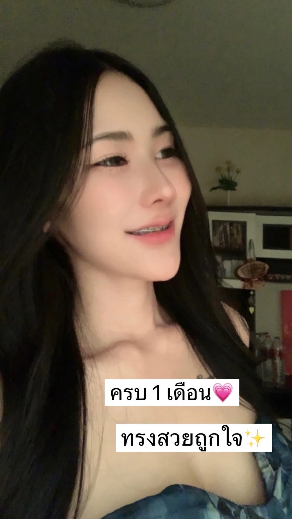แก้จมูก ปลายงุ้ม ปลายตก ด้วยเทคนิคเซมิกับอมิ