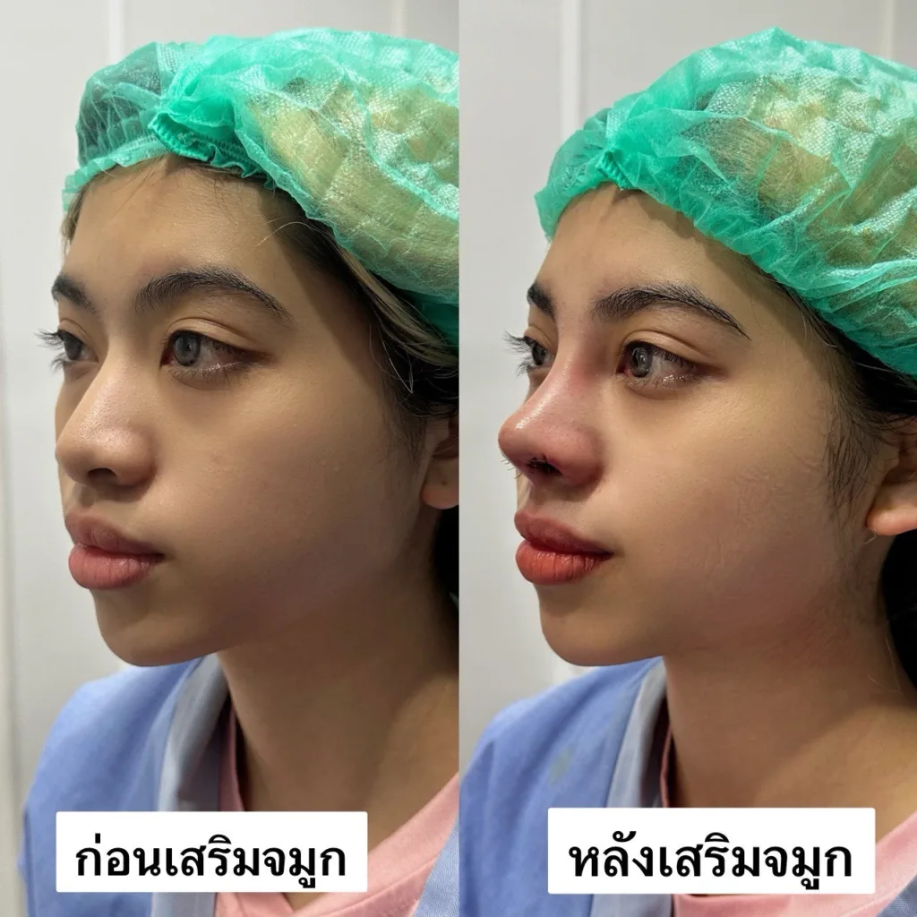 เสริมจมูก
