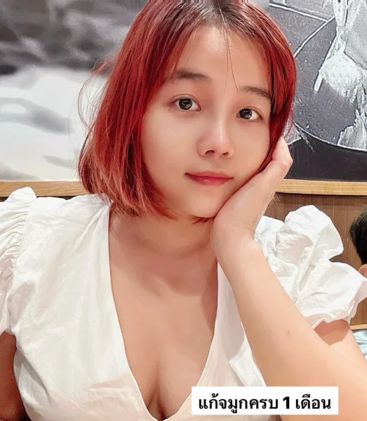 ซิลิโคนจมูก