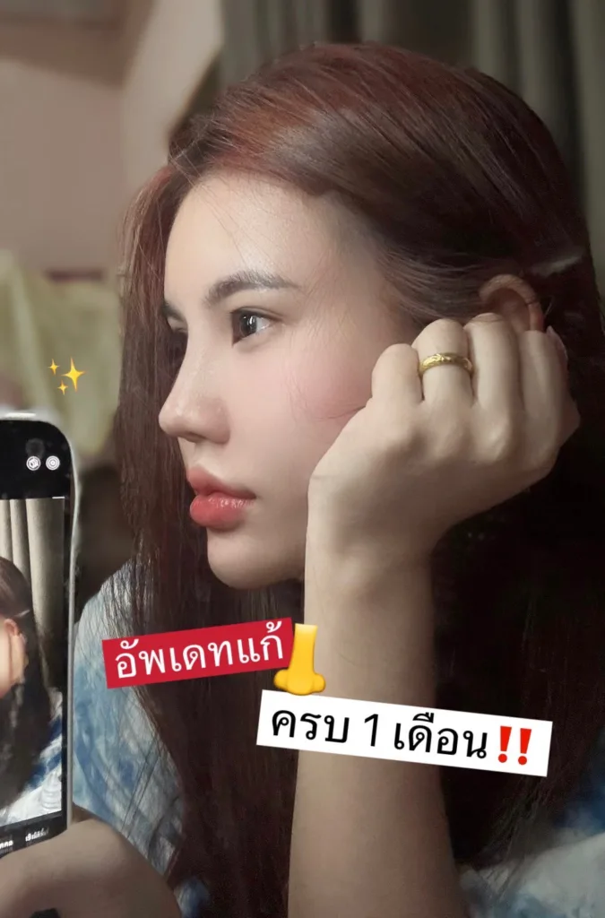 อัพเดทแก้จมูก