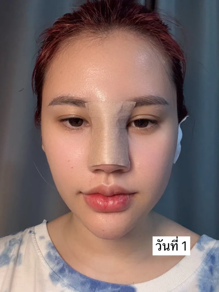 อัพเดทแก้จมูก