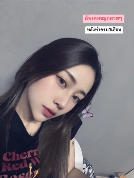 เสริมจมูก