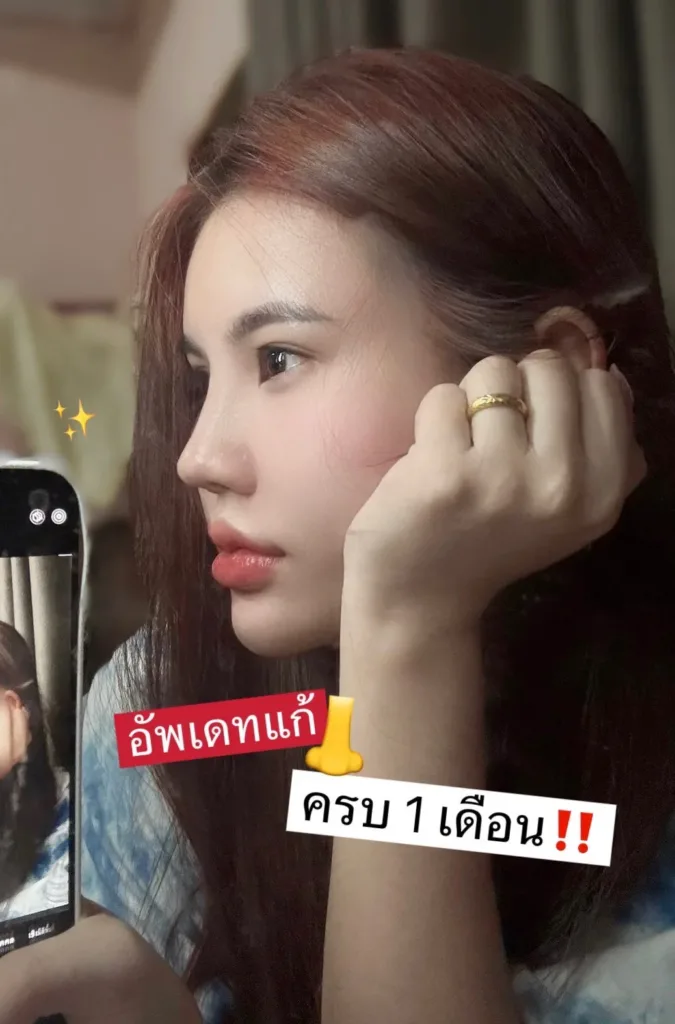 อัพเดทแก้จมูก