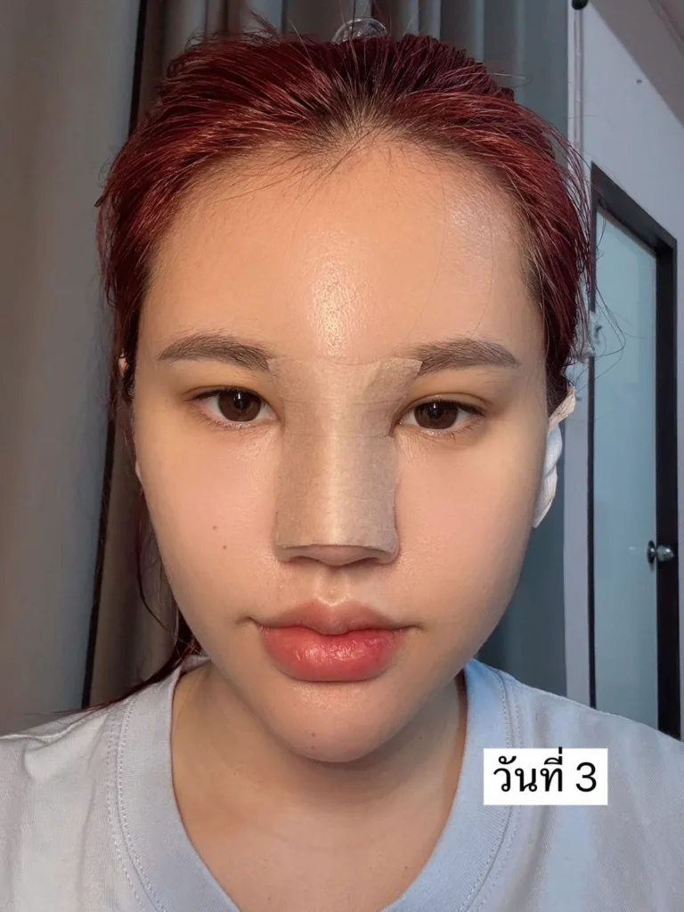อัพเดทแก้จมูก