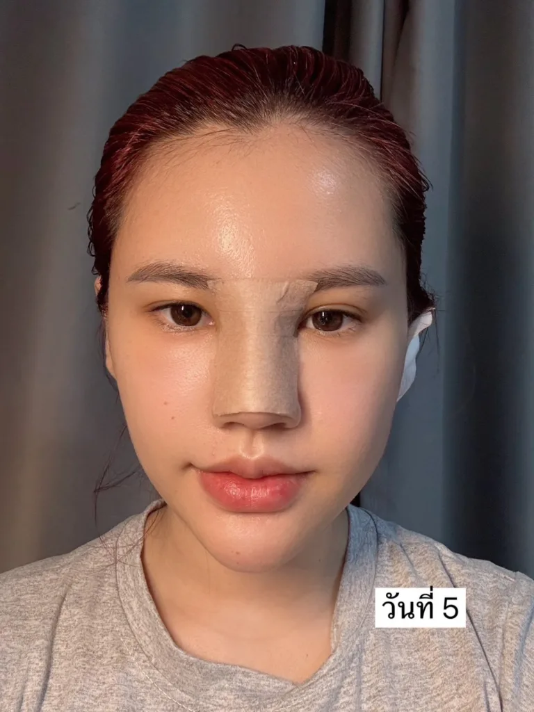 อัพเดทแก้จมูก
