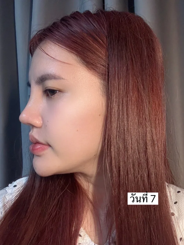 อัพเดทแก้จมูก