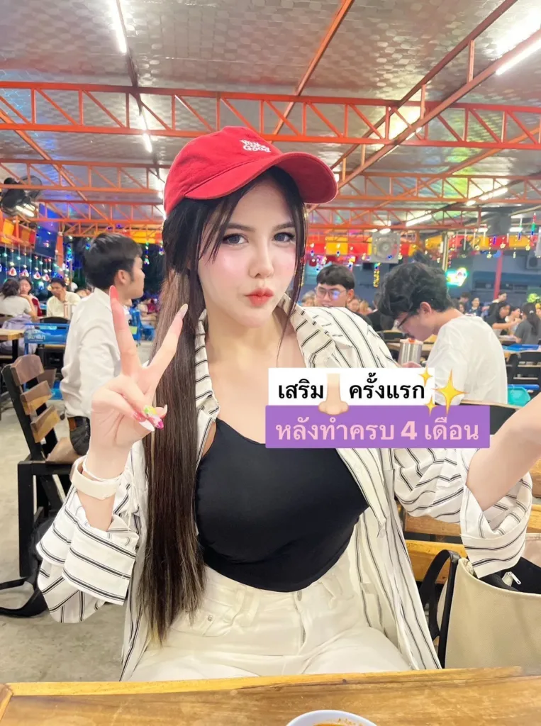 เสริมจมูก