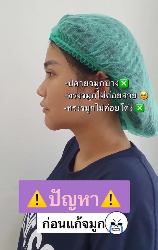 แก้จมูก