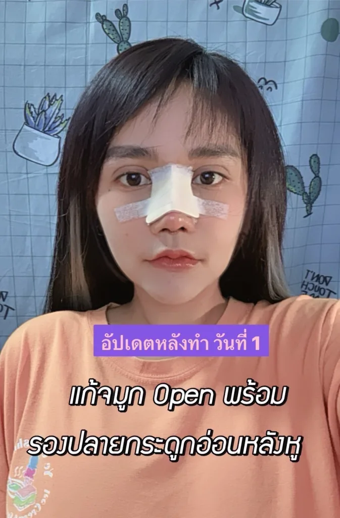 แก้จมูก