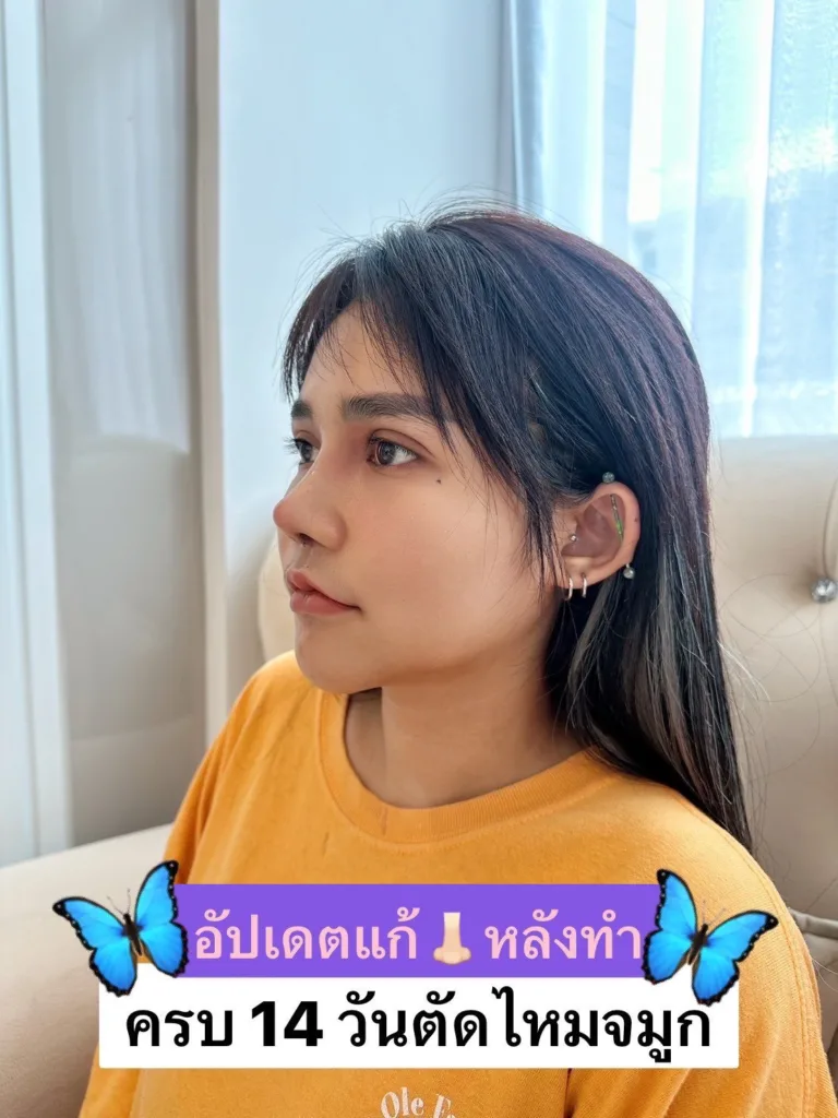 แก้จมูก