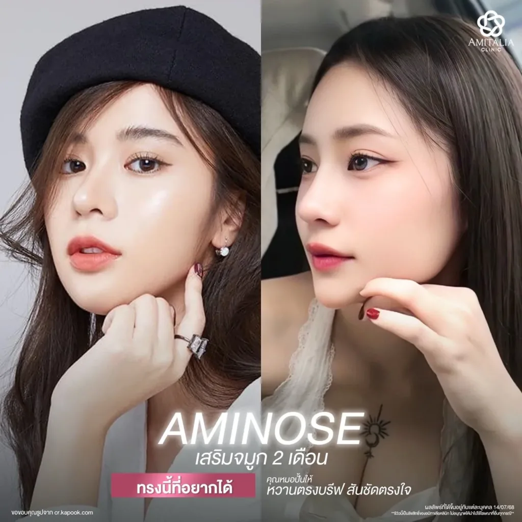 เสริมจมูก 2 เดือน