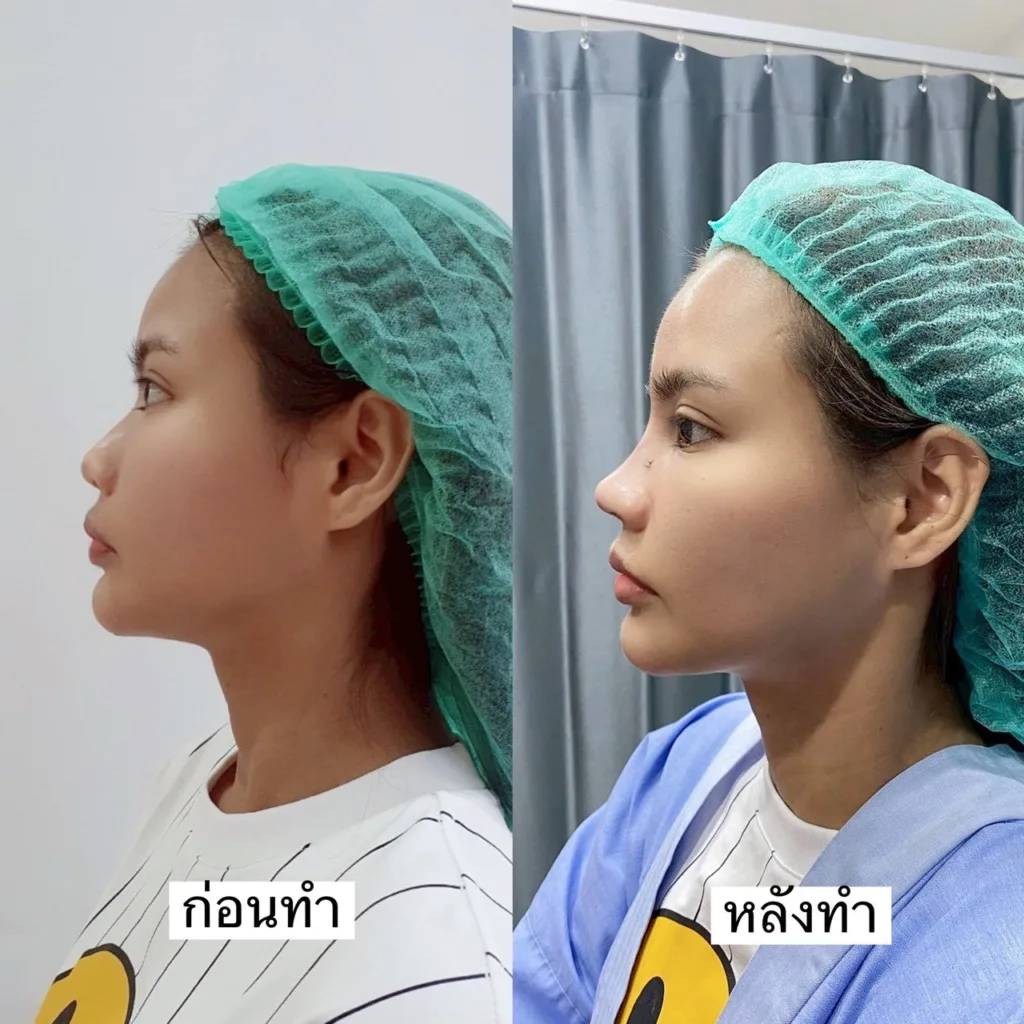 จมูกบาน จมูกบาน