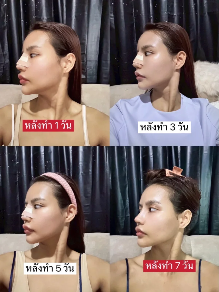จมูกบาน