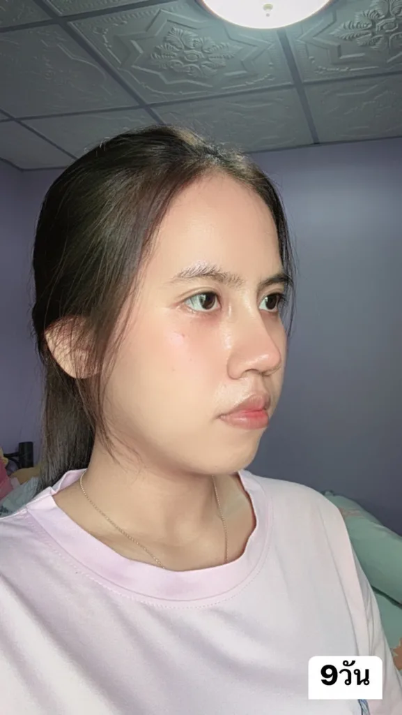 เสริมจมูก