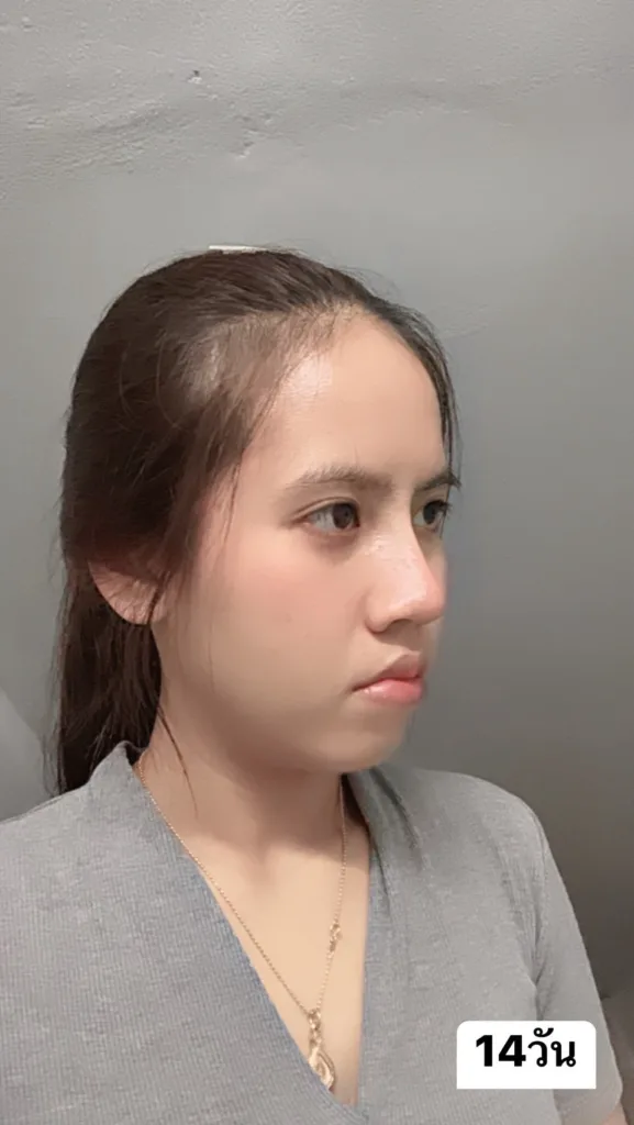 เสริมจมูก