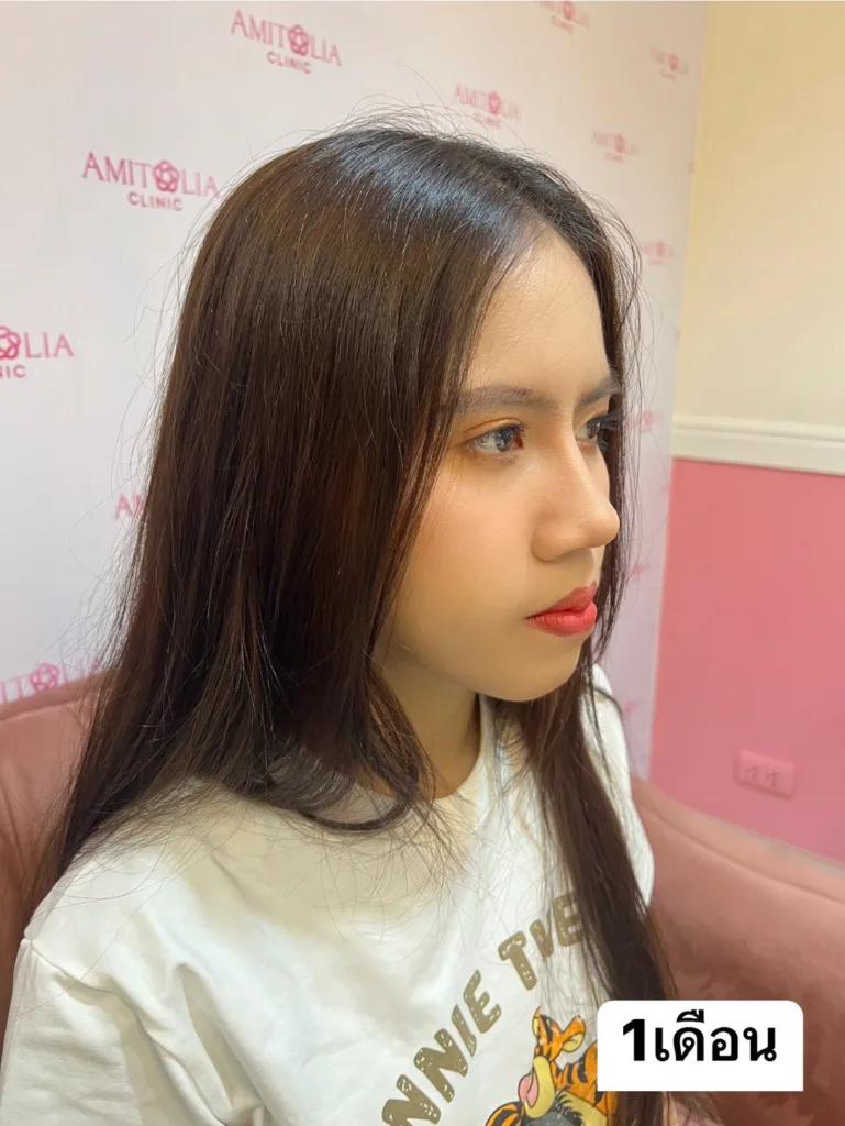 เสริมจมูก