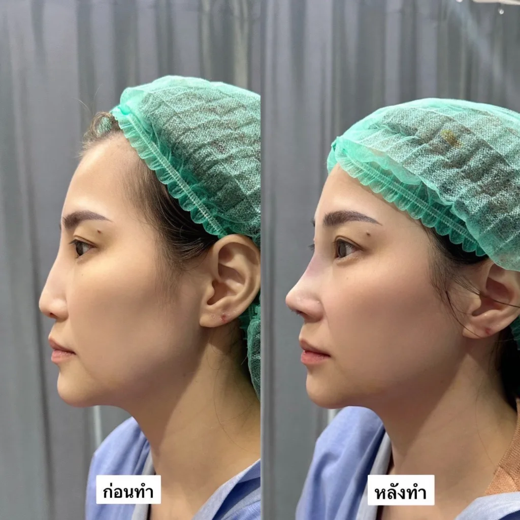 ทำศัลยกรรม