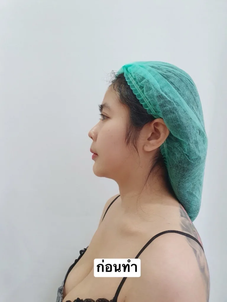 แก้จมูก