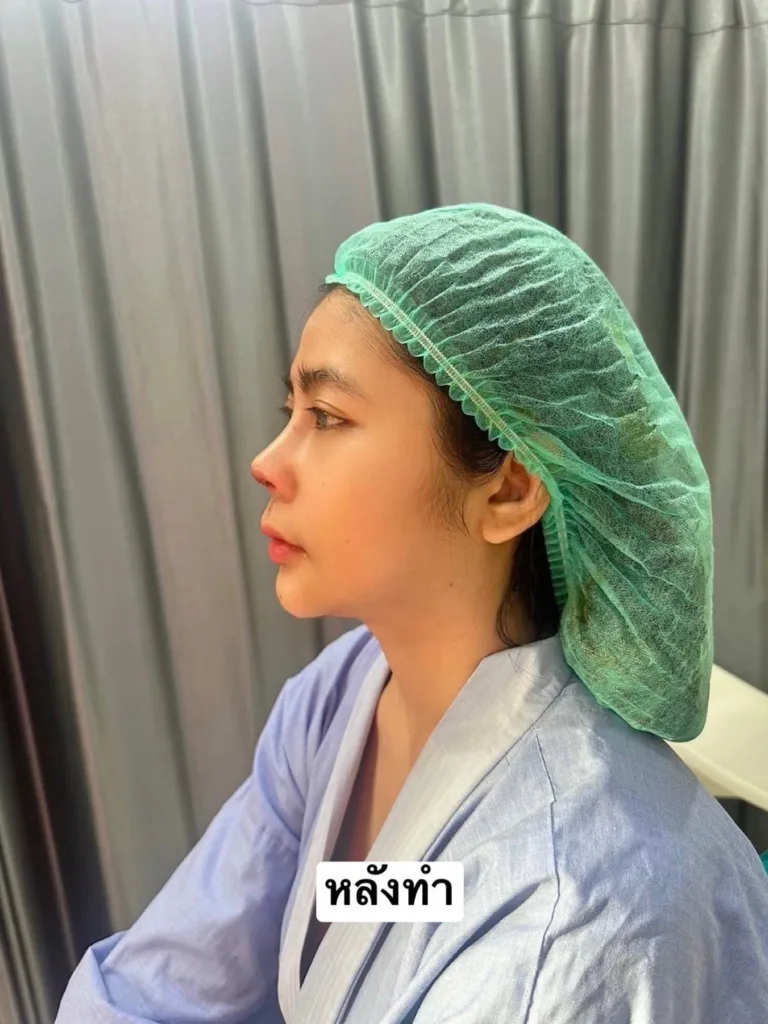 แก้จมูก