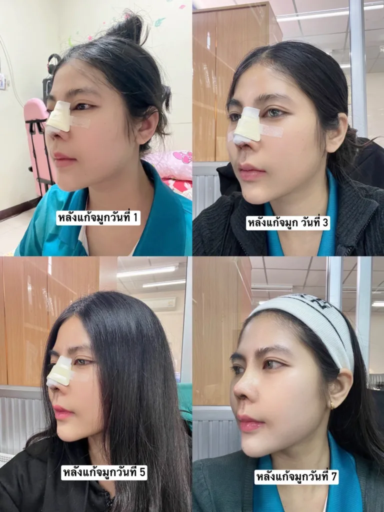 แก้จมูก