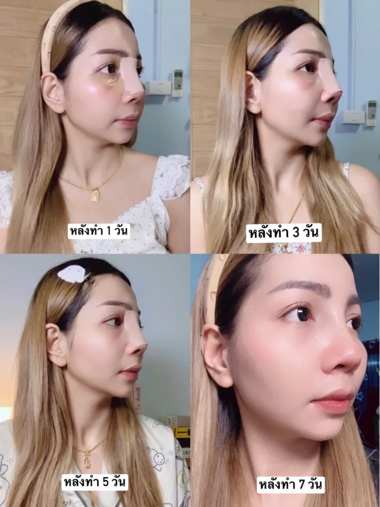 แก้จมูก