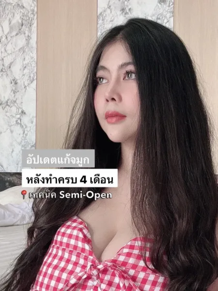 แก้จมูก