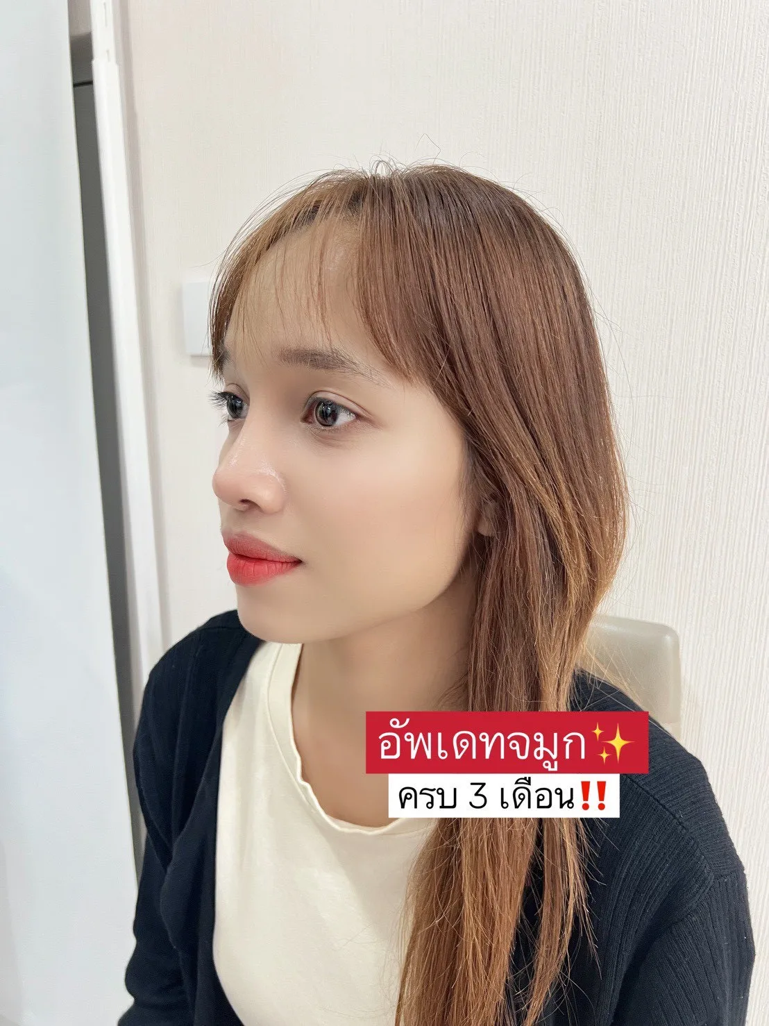 อัพเดทหลังทำจมูกแท่งแรกครบ 3 เดือนค่าา