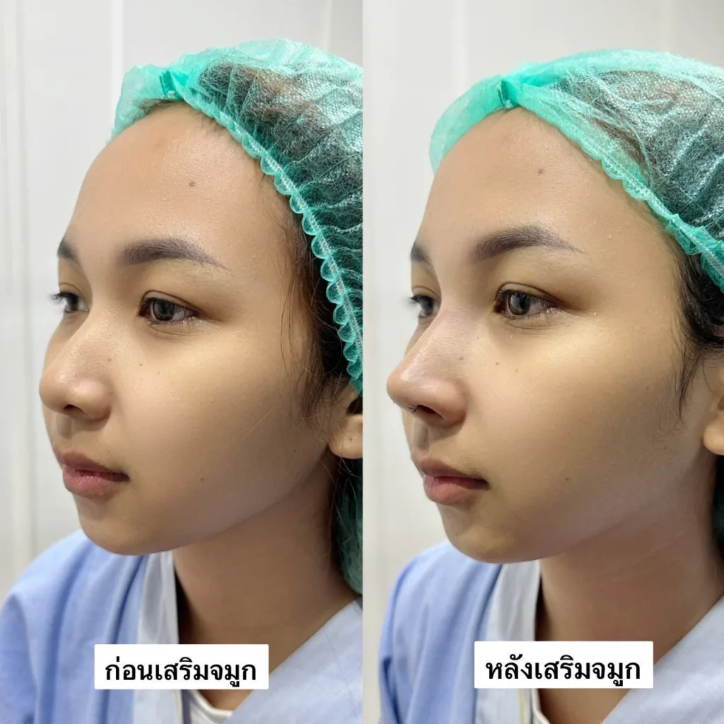 จมูกแท่งแรก