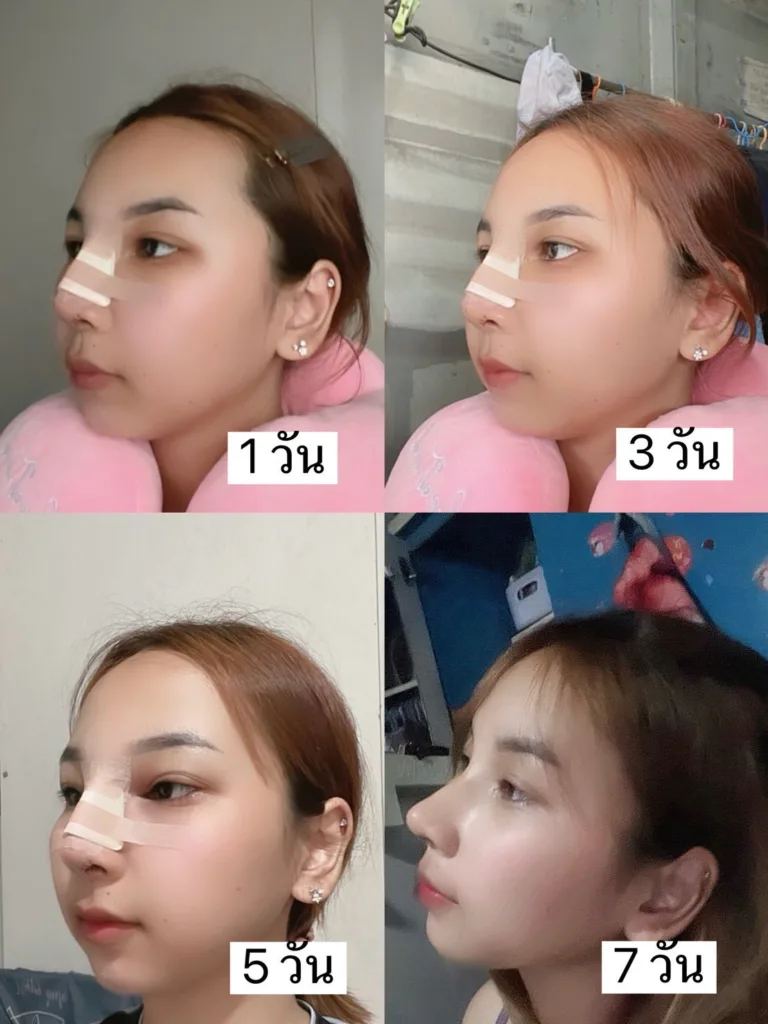 จมูกแท่งแรก