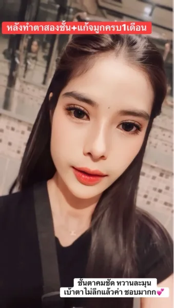 แก้จมูก+ทำตาสองชั้น