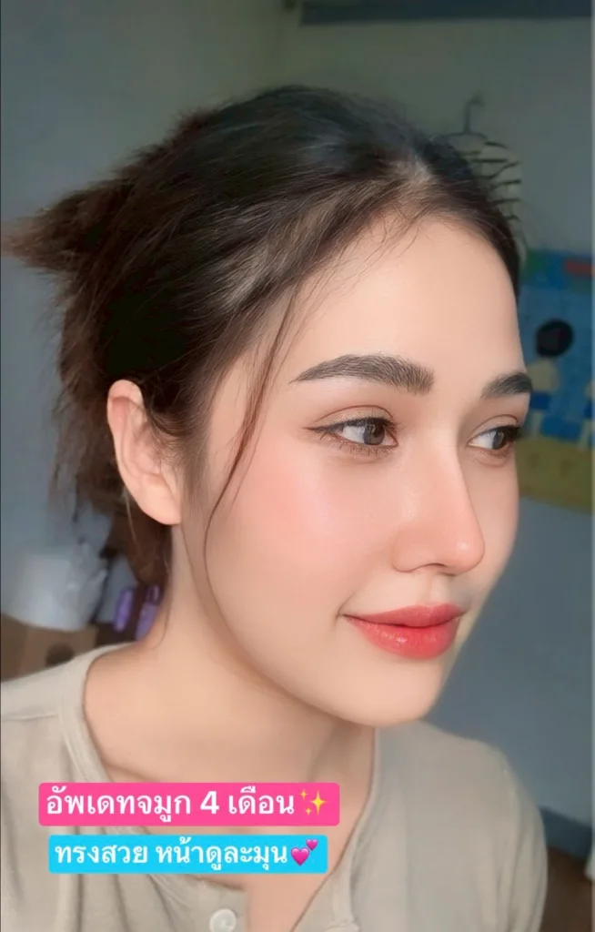 อัพเดทจมูก