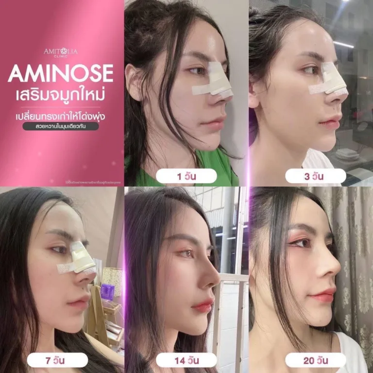 เสริมจมูกใหม่