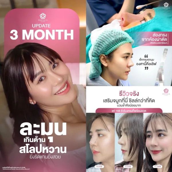 ทรงจมูก