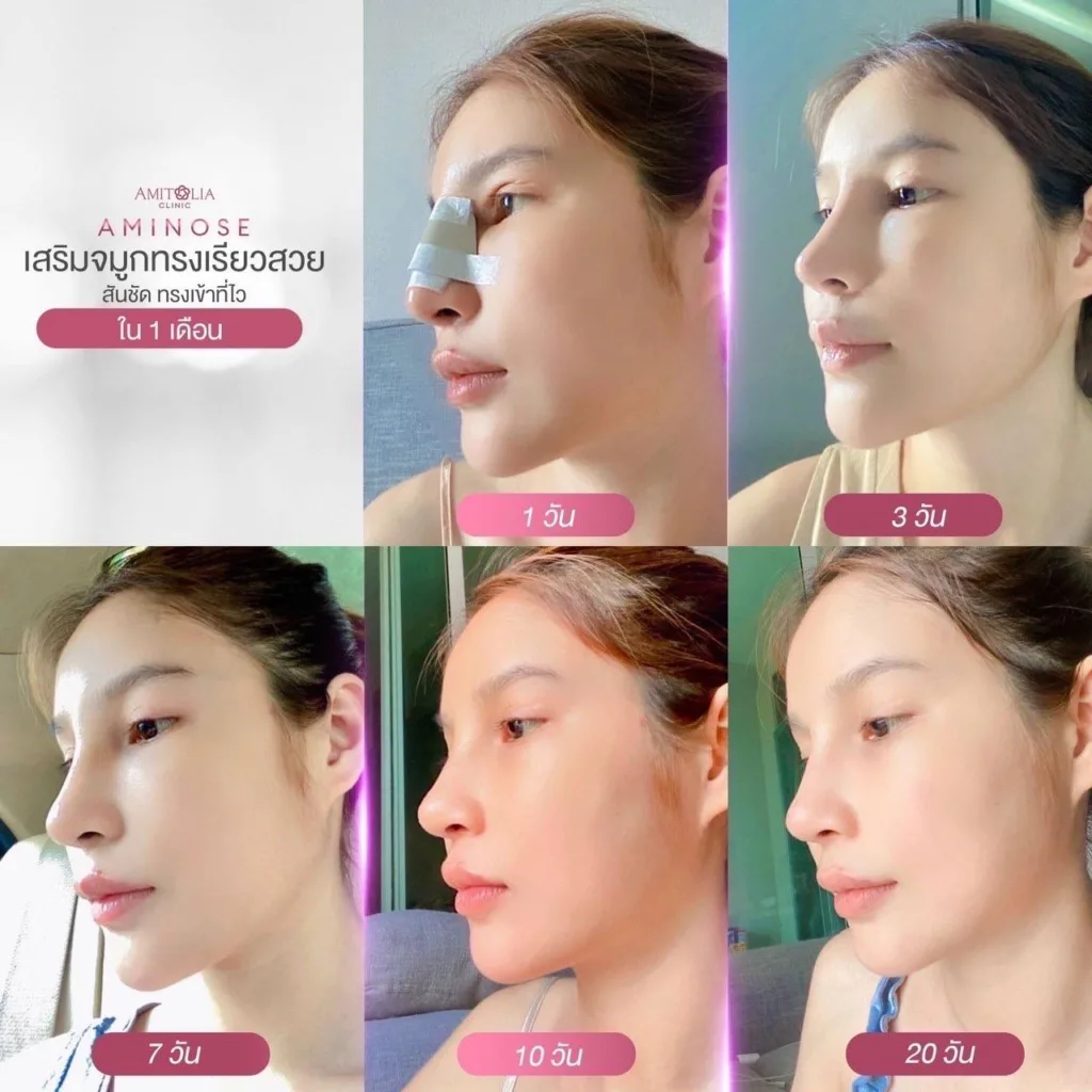 เสริมจมูก