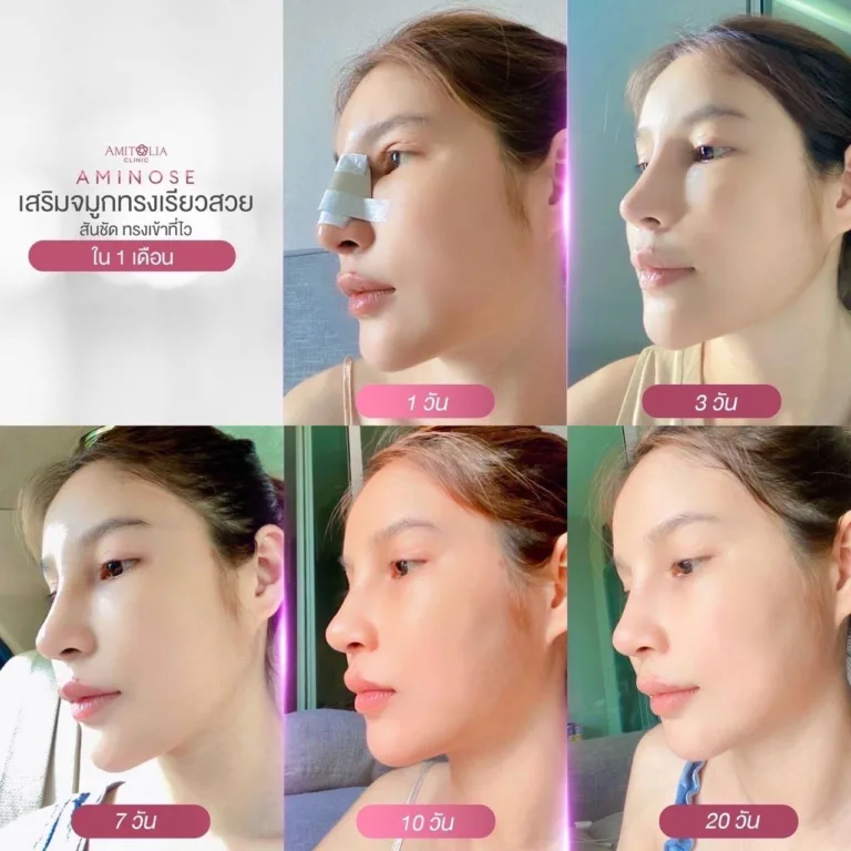 เสริมจมูก