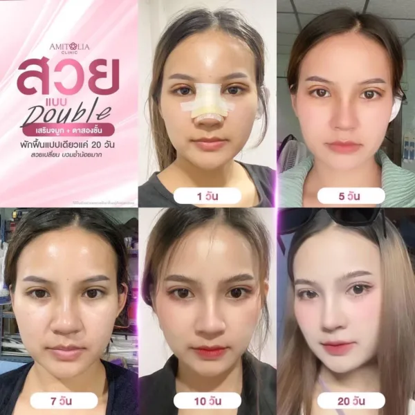 แก้จมูกพร้อมทำตา