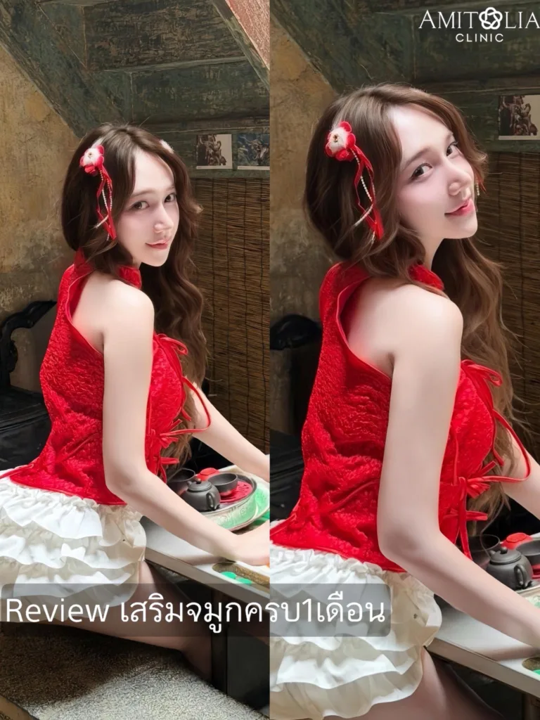 รีวิวเสริมจมูก