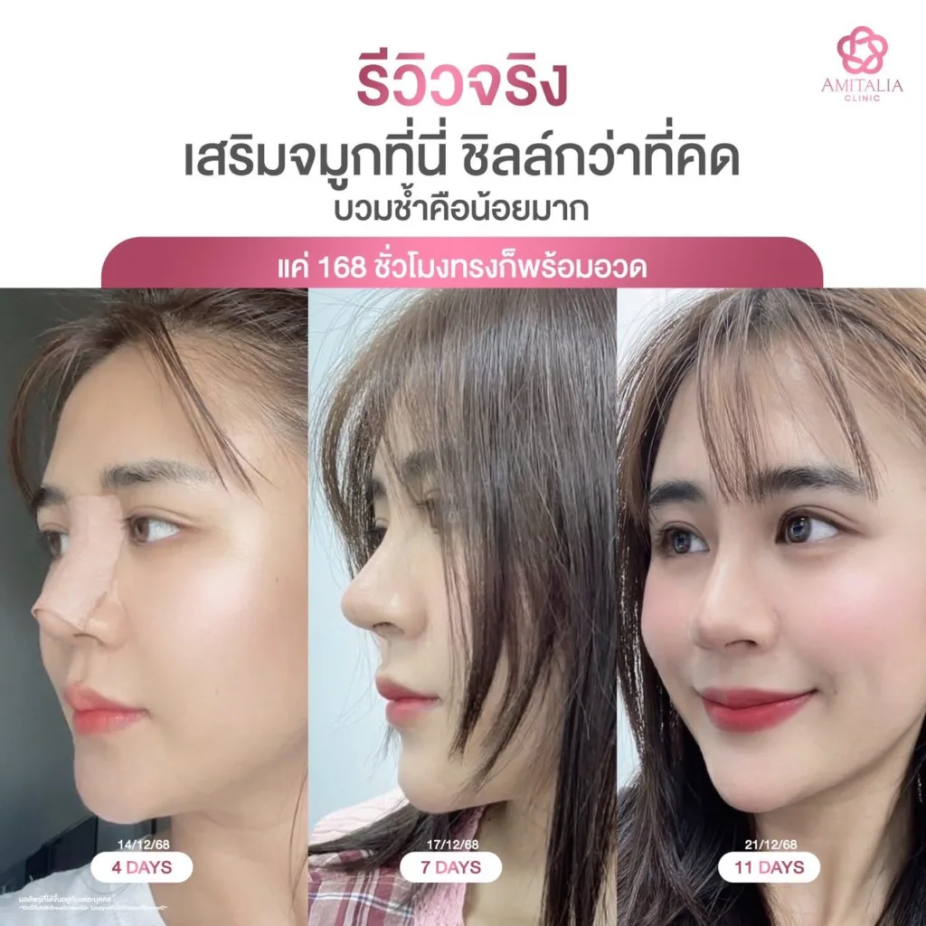 ทรงจมูก