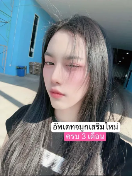 เสริมจมูก