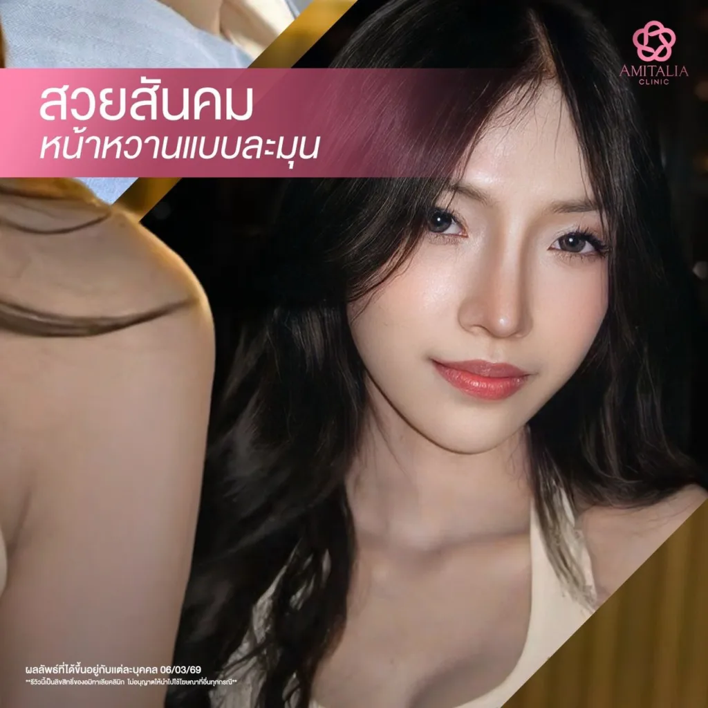 จมูกสั้น