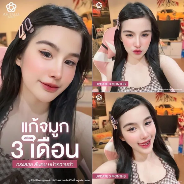 แก้จมูก