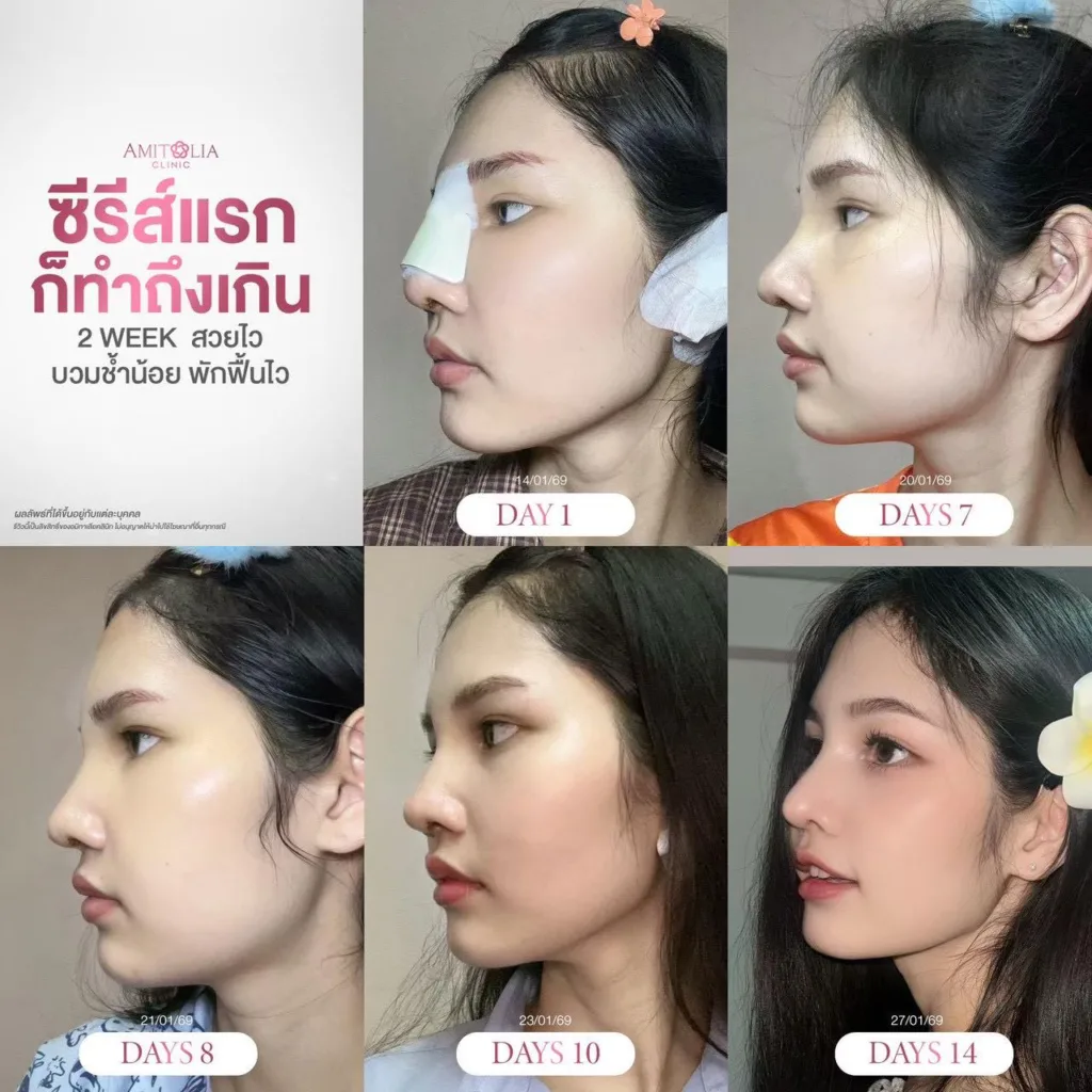 เสริมจมูกครั้งแรก