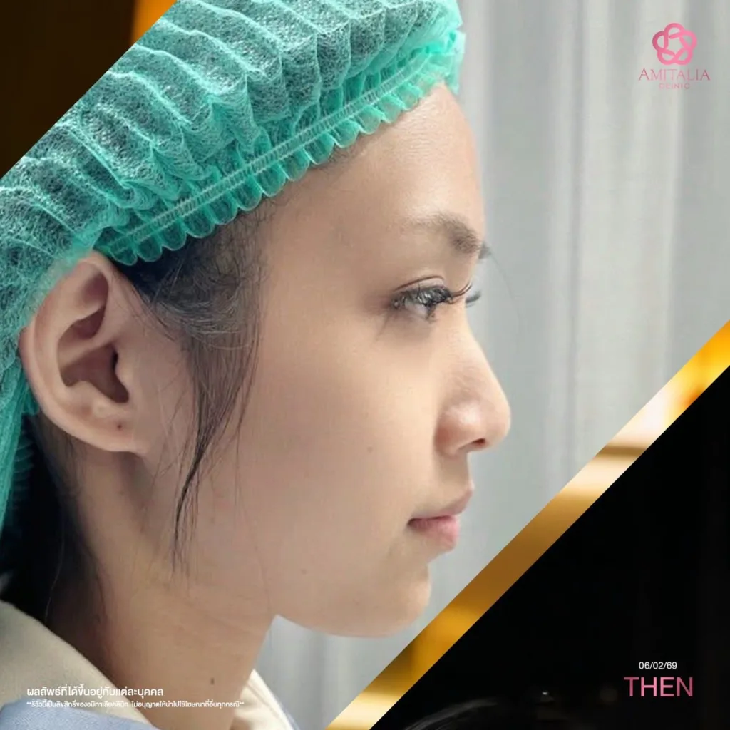 จมูกสั้น