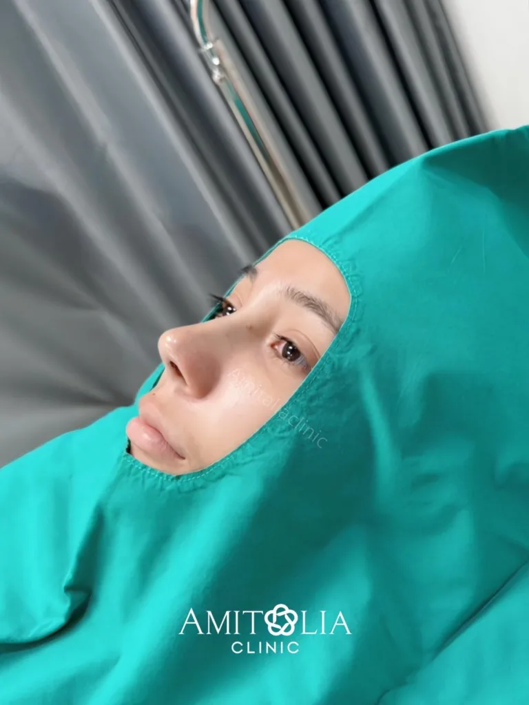 เสริมจมูก