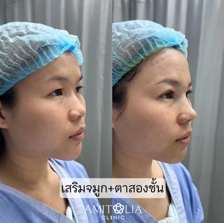 รีวิวเสริมจมูก